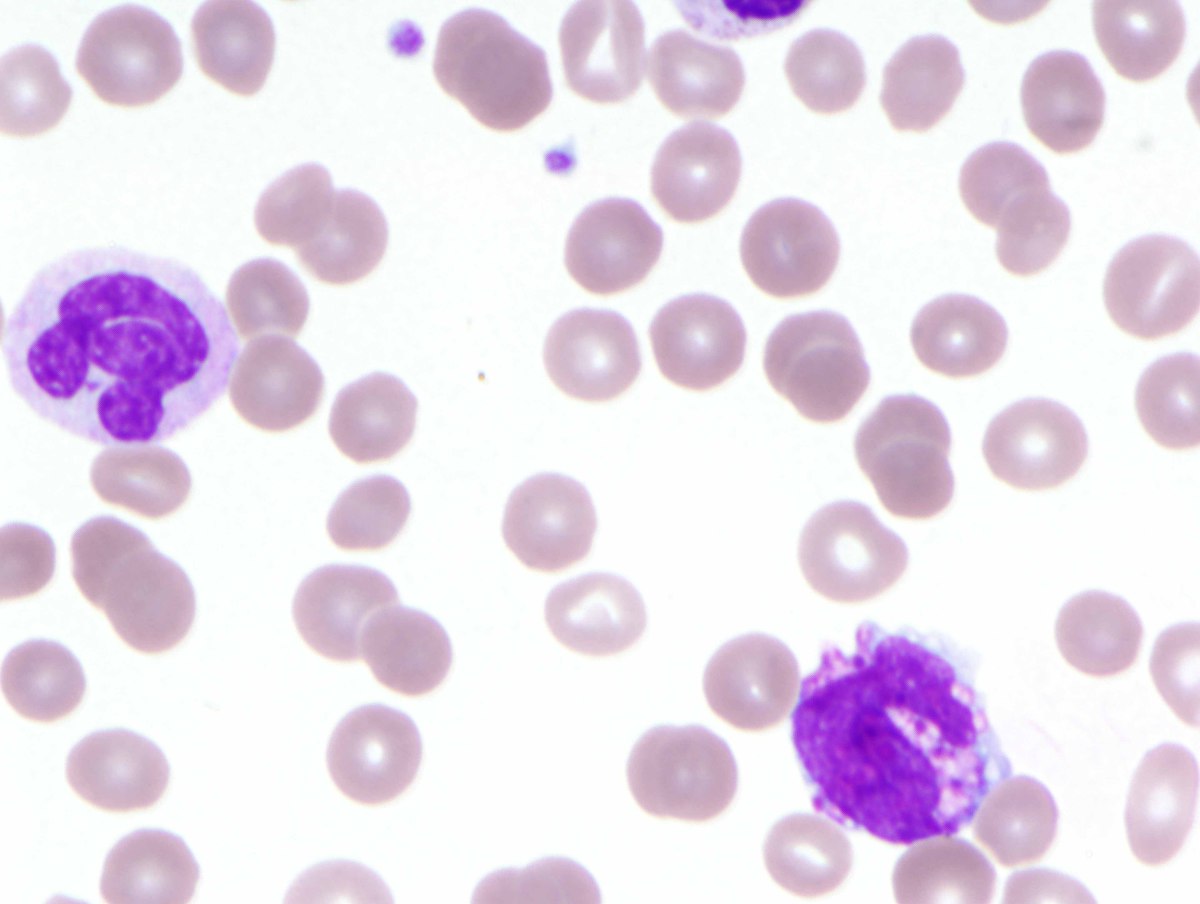 A) Peripheral blood smear with basophilia (Wright stain, 1000x oil)